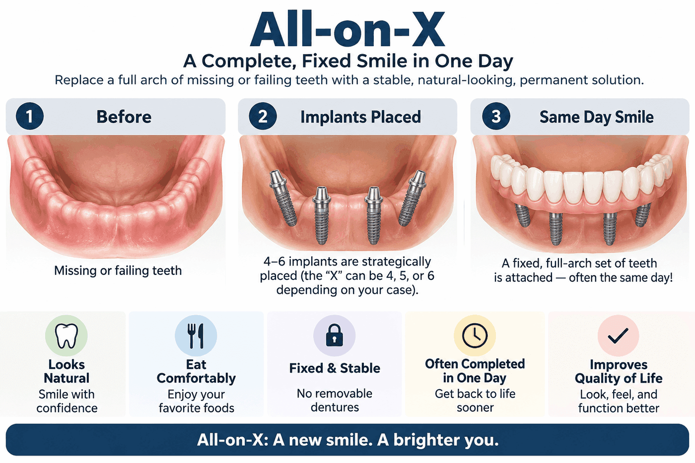 All-on-X infographic in three steps: before (missing or failing teeth), implants placed (4–6 strategically placed implants), and same-day smile (a fixed full-arch set of teeth attached). Benefits include looking natural, eating comfortably, fixed stability, often completing in one day, and improved quality of life.